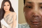 Hương Tràm, Dương Triệu Vũ và đồng nghiệp xót xa khi nhìn thấy gương mặt bị bỏng chín của ca sĩ Hồng Ngọc Hương Tràm, Dương Triệu Vũ và đồng nghiệp xót xa khi nhìn thấy gương mặt bị bỏng chín của ca sĩ Hồng Ngọc