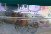 Bé 9 ngày tuổi nguy kịch do bị uốn ván Bé 9 ngày tuổi nguy kịch do bị uốn ván