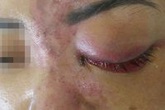 Tự tiêm filler làm đẹp, cô gái 20 tuổi ôm mũi hoại tử vào viện cấp cứu Tự tiêm filler làm đẹp, cô gái 20 tuổi ôm mũi hoại tử vào viện cấp cứu