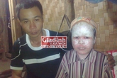 Mơ ước tương lai vô vọng của cậu bé "người cá" suýt bị dân bản chôn sống vì bệnh tật Mơ ước tương lai vô vọng của cậu bé "người cá" suýt bị dân bản chôn sống vì bệnh tật
