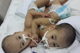 Sức khỏe hai bé được phẫu thuật tách rời đang dần ổn định Sức khỏe hai bé được phẫu thuật tách rời đang dần ổn định