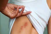 Hàng loạt người nhập viện do bị kiến lạ đốt Hàng loạt người nhập viện do bị kiến lạ đốt