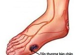 Chủ quan với biến chứng tiểu đường có thể gây đoạn chi Chủ quan với biến chứng tiểu đường có thể gây đoạn chi