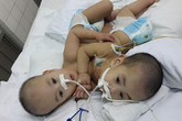 2 em bé dính liền tim, gan ở Sài Gòn đã được tách rời thành công 2 em bé dính liền tim, gan ở Sài Gòn đã được tách rời thành công