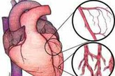 Bệnh viện Đa khoa tỉnh Thanh Hóa thực hiện thành công can thiệp tim mạch Bệnh viện Đa khoa tỉnh Thanh Hóa thực hiện thành công can thiệp tim mạch