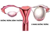 Bị u nang buồng trứng sẽ khó có con? Bị u nang buồng trứng sẽ khó có con?