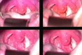 Phòng ngừa viêm họng cấp lúc chuyển mùa Phòng ngừa viêm họng cấp lúc chuyển mùa