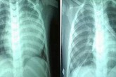 Cứu sống bệnh nhi 2 tuổi bị bệnh tim hiếm gặp Cứu sống bệnh nhi 2 tuổi bị bệnh tim hiếm gặp