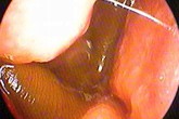 Con vắt béo núc ních sống trong mũi bệnh nhân Con vắt béo núc ních sống trong mũi bệnh nhân