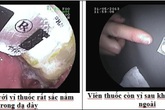Thuốc còn nguyên vỉ nằm gọn trong dạ dày bệnh nhân Thuốc còn nguyên vỉ nằm gọn trong dạ dày bệnh nhân