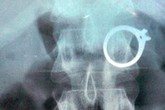 Nuốt nhẫn, vòng vàng để tẩu tán tang vật Nuốt nhẫn, vòng vàng để tẩu tán tang vật