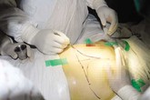 Phẫu thuật thẩm mỹ nâng ngực: Phương pháp hút mỡ đã bị bỏ từ lâu Phẫu thuật thẩm mỹ nâng ngực: Phương pháp hút mỡ đã bị bỏ từ lâu
