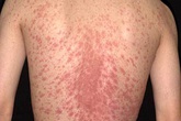Tẩy sạch các bệnh vẩy trên da bằng những sản phẩm thiên nhiên Tẩy sạch các bệnh vẩy trên da bằng những sản phẩm thiên nhiên