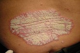 Vẩy nến – Nỗi thống khổ dai dẳng Vẩy nến – Nỗi thống khổ dai dẳng