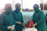 Bóc khối u xơ tử cung “siêu khủng” nặng gần… 10kg Bóc khối u xơ tử cung “siêu khủng” nặng gần… 10kg