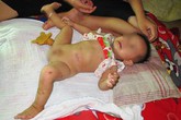 Bất hạnh bé 14 tháng không có hậu môn, bàng quang lồi trên ổ bụng Bất hạnh bé 14 tháng không có hậu môn, bàng quang lồi trên ổ bụng