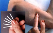 Dùng que cấy tránh thai và nỗi lo mất kinh Dùng que cấy tránh thai và nỗi lo mất kinh