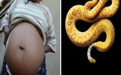 Kinh sợ rắn chui vào, sinh sống trong bụng người Kinh sợ rắn chui vào, sinh sống trong bụng người