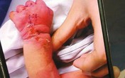 Mẹ tâm thần cắn nát tay con trai vừa sinh Mẹ tâm thần cắn nát tay con trai vừa sinh