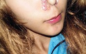 Quảng cáo kẹp nâng mũi chỉ là bịp bợm Quảng cáo kẹp nâng mũi chỉ là bịp bợm