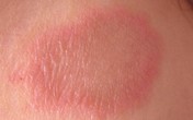 Điều trị bệnh vẩy phấn hồng Điều trị bệnh vẩy phấn hồng