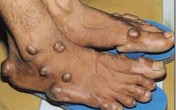 Hỏi và đáp về bệnh gút Hỏi và đáp về bệnh gút