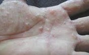 Bệnh chàm tổ đĩa và cách trị bằng đông y Bệnh chàm tổ đĩa và cách trị bằng đông y