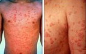 Hỏi đáp về bệnh vẩy nến thể giọt Hỏi đáp về bệnh vẩy nến thể giọt