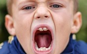 Lạ kỳ cậu bé có 4 hàm răng Lạ kỳ cậu bé có 4 hàm răng