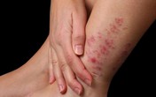 Dùng thuốc nào trị vảy nến hiệu quả? Dùng thuốc nào trị vảy nến hiệu quả?