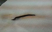 Kinh hãi đỉa dài gần 5cm bám sâu trong lỗ mũi Kinh hãi đỉa dài gần 5cm bám sâu trong lỗ mũi