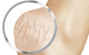 Nứt gót chân Chứng bệnh của mùa lạnh Nứt gót chân Chứng bệnh của mùa lạnh