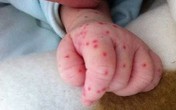 Phân biệt sốt xuất huyết và sốt phát ban Phân biệt sốt xuất huyết và sốt phát ban