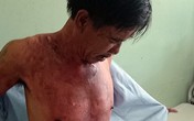 Bị đánh, vợ tạt cháo nóng vào chồng Bị đánh, vợ tạt cháo nóng vào chồng