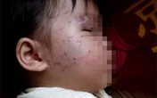 Bé 11 tháng tuổi bị bạn cắn, cào nát mặt khi đi nhà trẻ Bé 11 tháng tuổi bị bạn cắn, cào nát mặt khi đi nhà trẻ