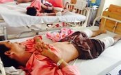 Bị bỏng axit đậm đặc khi đang làm việc Bị bỏng axit đậm đặc khi đang làm việc