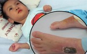 Đau đớn cảnh bé 28 tháng tuổi bất động vì lao màng não Đau đớn cảnh bé 28 tháng tuổi bất động vì lao màng não