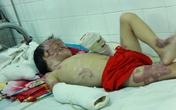 Vòng tay nhân ái (MS 135): Hoàn cảnh thương tâm của cháu bé bị bỏng làm biến dạng mặt Vòng tay nhân ái (MS 135): Hoàn cảnh thương tâm của cháu bé bị bỏng làm biến dạng mặt