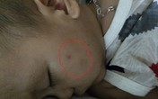 Bé trai 15 tháng tuổi bị bạo hành rất hoảng loạn, sốt và sợ người lạ Bé trai 15 tháng tuổi bị bạo hành rất hoảng loạn, sốt và sợ người lạ