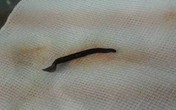 Gắp con đỉa dài 4,5 cm thập thò cửa mũi Gắp con đỉa dài 4,5 cm thập thò cửa mũi