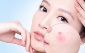 Bí quyết loại bỏ mụn trứng cá bọc Bí quyết loại bỏ mụn trứng cá bọc