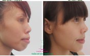 Phẫu thuật thẩm mỹ đơn giản để hết hô, móm Phẫu thuật thẩm mỹ đơn giản để hết hô, móm