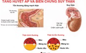 Bệnh tăng huyết áp có thể dẫn đến suy thận Bệnh tăng huyết áp có thể dẫn đến suy thận