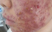Hãi hùng “tiên dược làm đẹp” siêu rẻ và những hệ lụy khôn lường Hãi hùng “tiên dược làm đẹp” siêu rẻ và những hệ lụy khôn lường