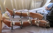 Cắn răng đau đớn để cao thêm 7,5 cm sau 3 tháng Cắn răng đau đớn để cao thêm 7,5 cm sau 3 tháng