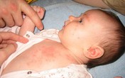 Hỏi đáp trị rôm sảy cho trẻ Hỏi đáp trị rôm sảy cho trẻ
