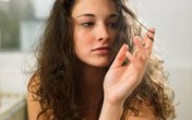 8 mẹo trị hói đầu hiệu quả 8 mẹo trị hói đầu hiệu quả