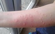 Dấu hiệu bệnh nguy hiểm từ mề đay Dấu hiệu bệnh nguy hiểm từ mề đay