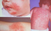 Làm gì để trẻ ít dị ứng khi trưởng thành? Làm gì để trẻ ít dị ứng khi trưởng thành?