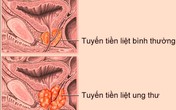 Điều trị thành công ung thư bằng phương pháp cấy hạt phóng xạ Điều trị thành công ung thư bằng phương pháp cấy hạt phóng xạ